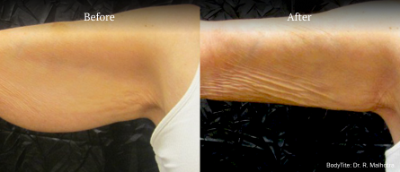 bodytite treatment before and after