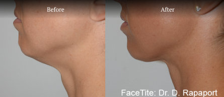 FaceTite Before & After