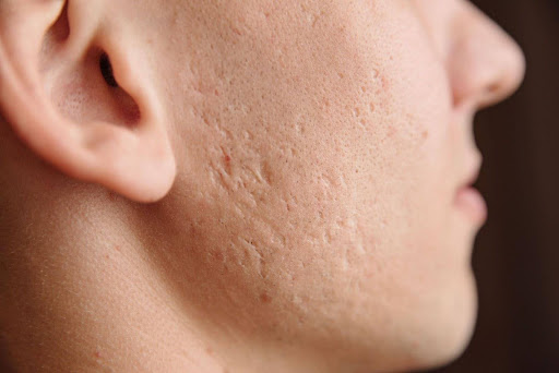 Benefits of Acne Scar Skin Treatment