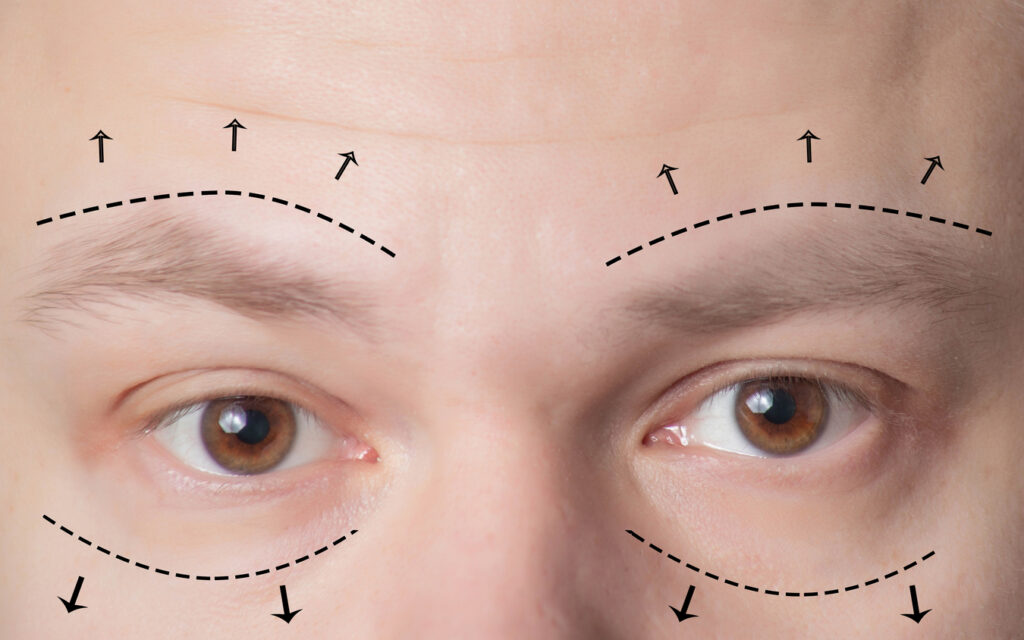 Benefits of Eyebrow Ptosis Treatment