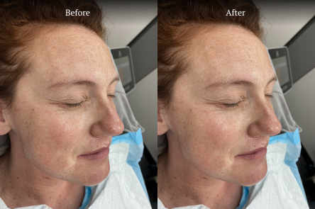 Fine Lines and Wrinkles before after