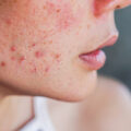 how to get rid of acne scarring