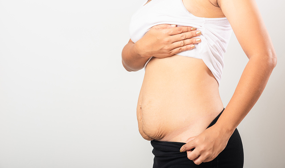 Your Guide on How to Reduce Postpartum Belly