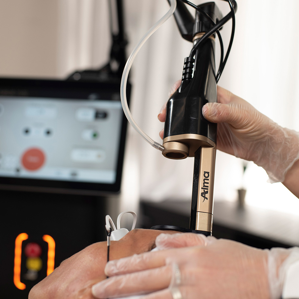 hyperpigmentation treatment, laser skin rejuvenation, excess pigmentation, skin renewal, skin clarity