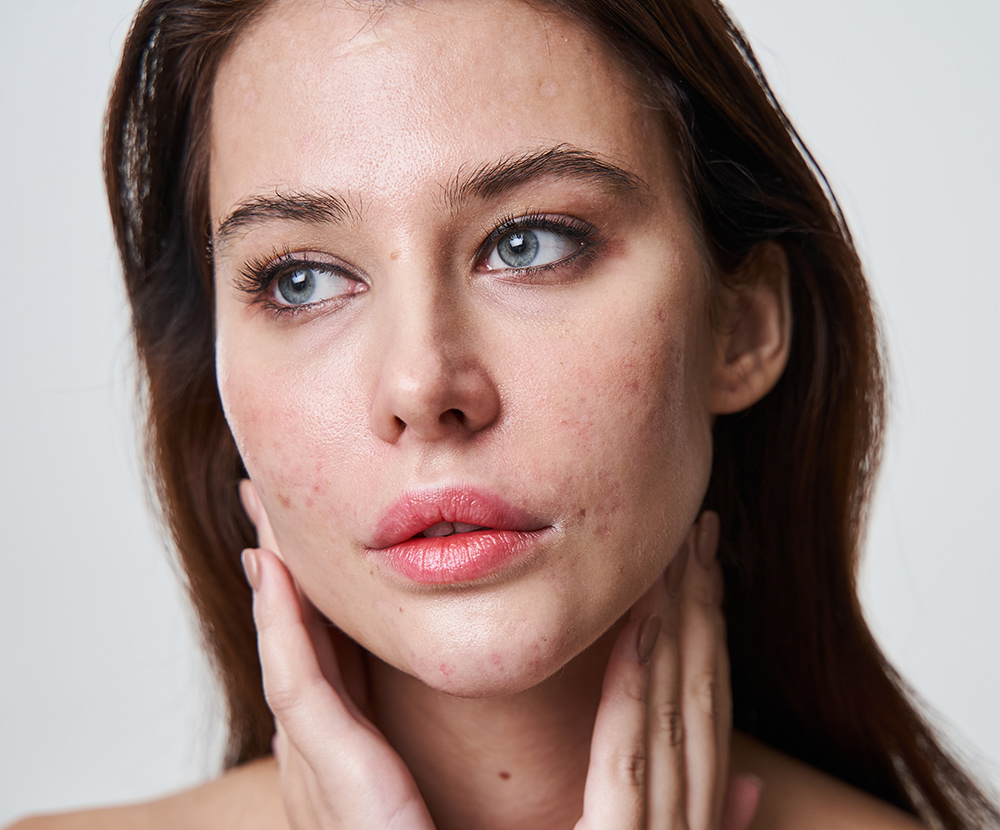 chemical peel treatment, uneven skin tone, sun damage