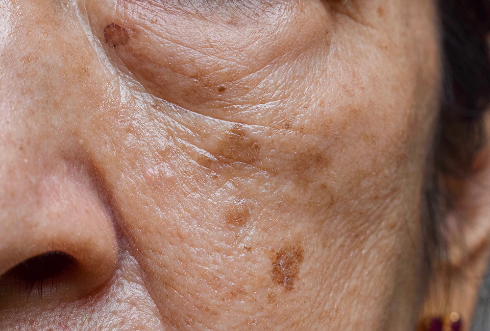 hyperpigmentation treatment, dark spots, sun damage, uneven skin tone, balanced complexion
