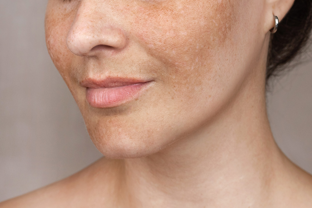 laser skin rejuvenation treatment, sun-damaged skin, uneven skin tone, skin texture improvement