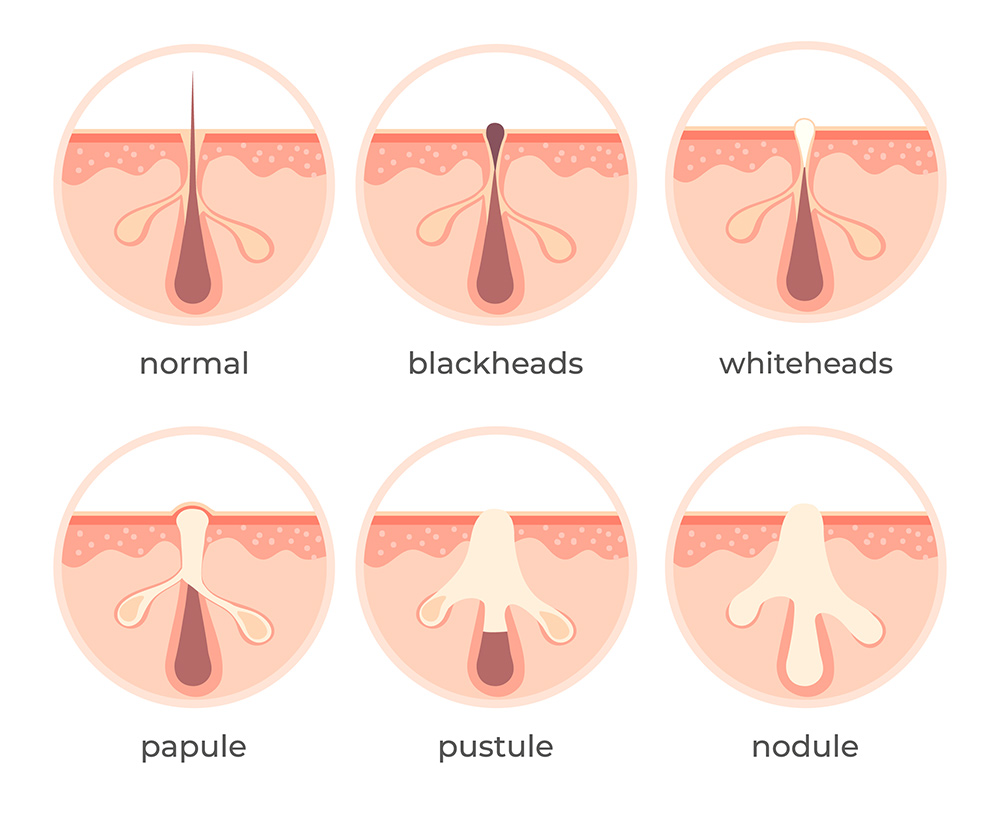 types of acne, comedonal acne, blackheads, whiteheads