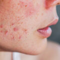 types of acne, comedonal acne, blackheads, whiteheads