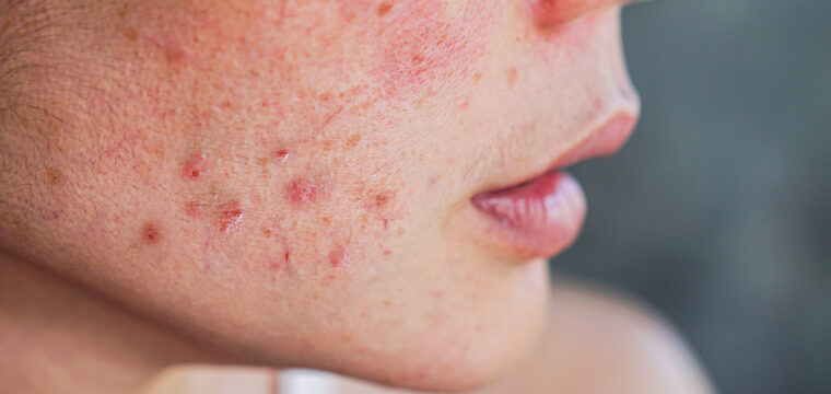 types of acne, comedonal acne, blackheads, whiteheads