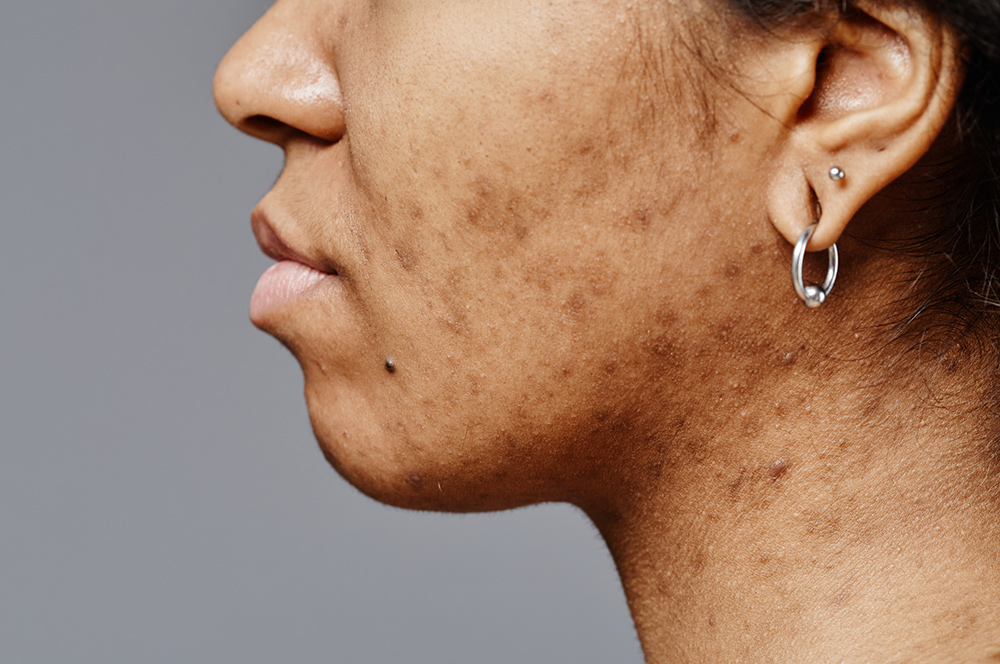 sun damage treatment, photoaged skin, skin renewal