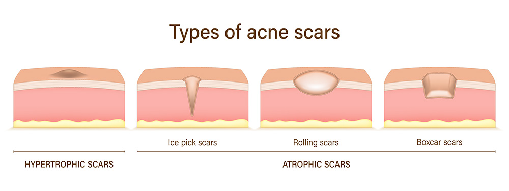 scar removal treatment, scar tissue, types of acne scars