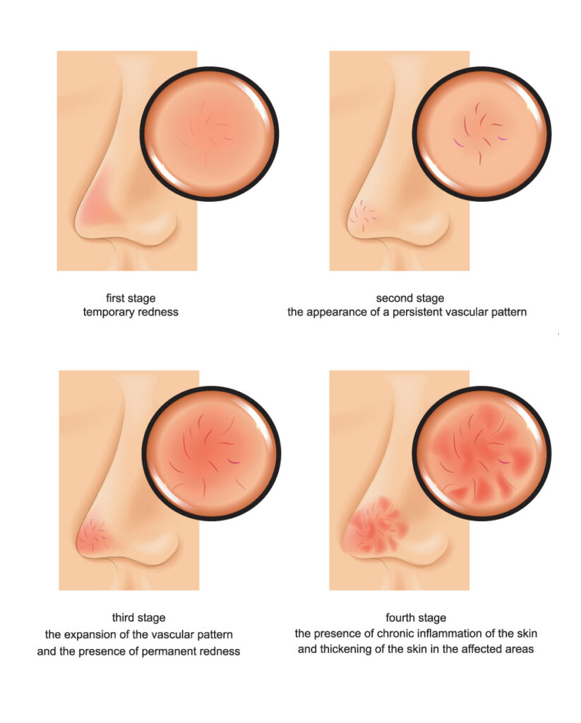 stages of rosacea