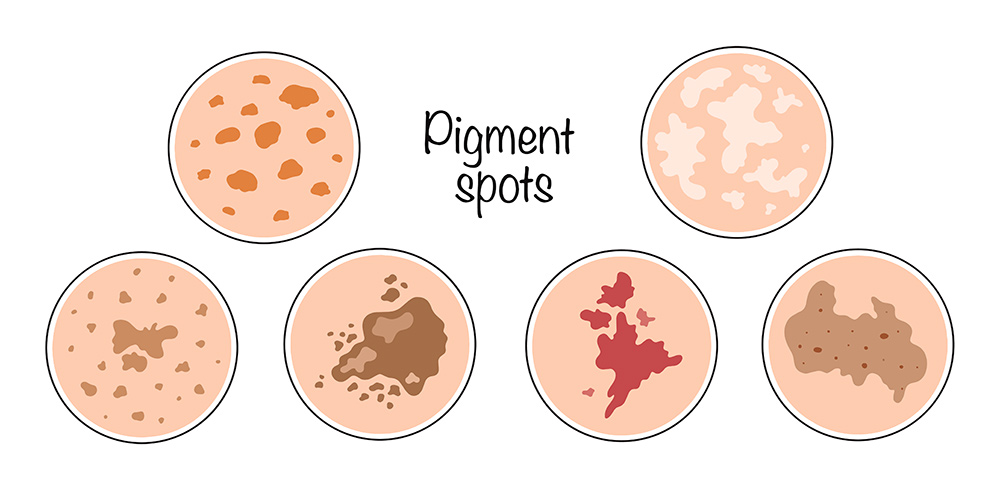 What is hyperpigmentation, darker skin areas, excess melanin