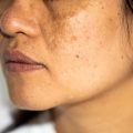 what is hyperpigmentation hyperpigmentation causes types of hyperpigmentation hyperpigmentation skin condition hyperpigmentation treatment options