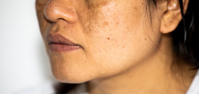 what is hyperpigmentation hyperpigmentation causes types of hyperpigmentation hyperpigmentation skin condition hyperpigmentation treatment options