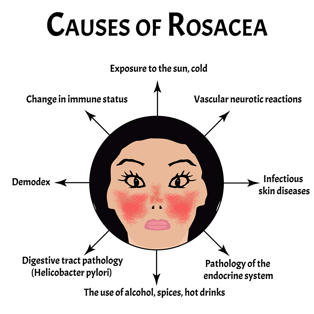 rosacea symptoms, visible capillaries, redness on face