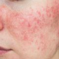 rosacea symptoms early signs of rosacea identifying rosacea rosacea flare-ups
