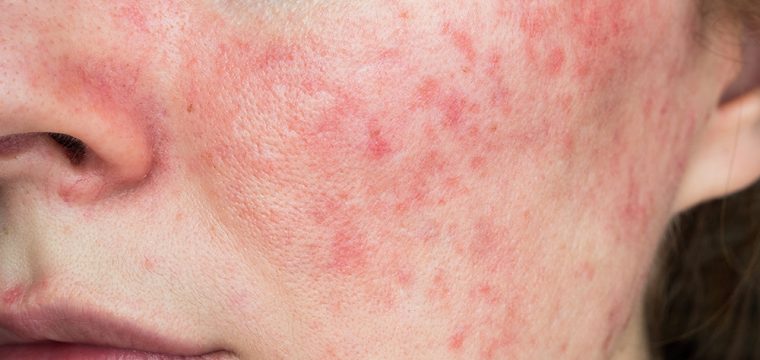 rosacea symptoms early signs of rosacea identifying rosacea rosacea flare-ups