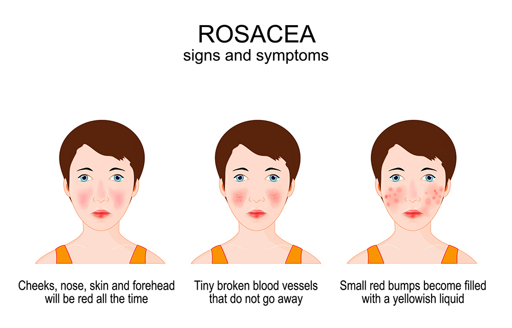rosacea symptoms, facial redness, early signs of rosacea