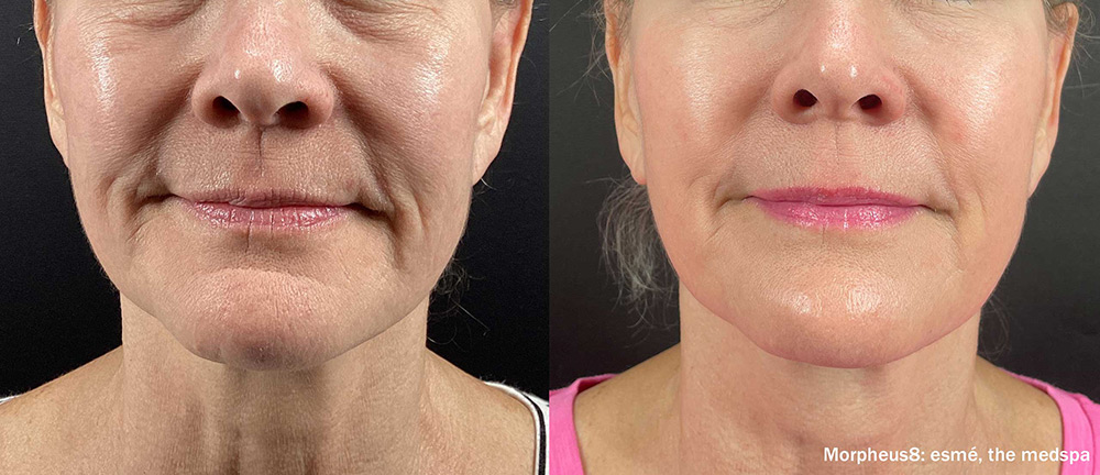 skin rejuvenation and resurfacing, skin resurfacing treatments, acne scar treatment, skin texture improvement