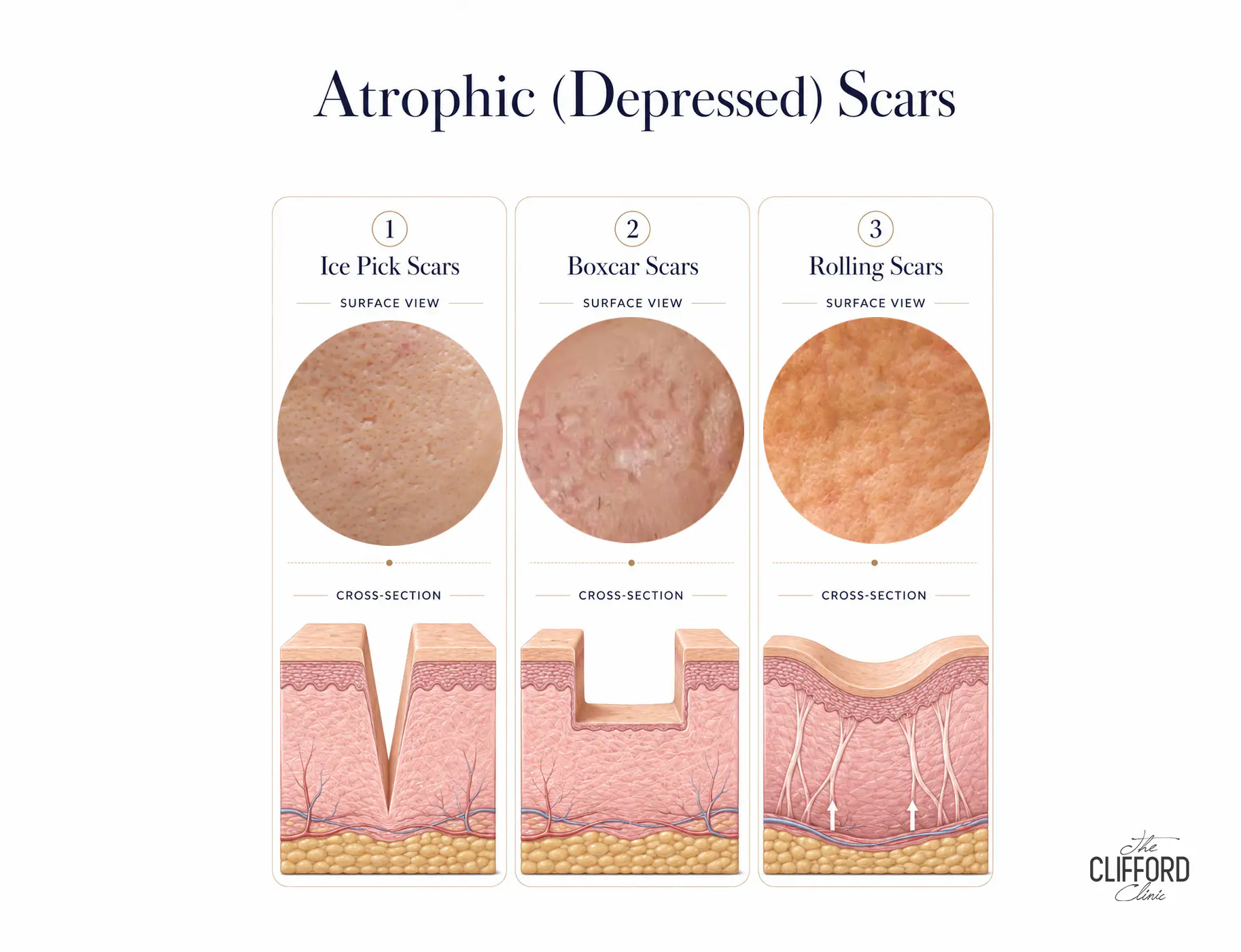 A clinical assessment can identify mixed scar patterns and help guide appropriate treatment planning.