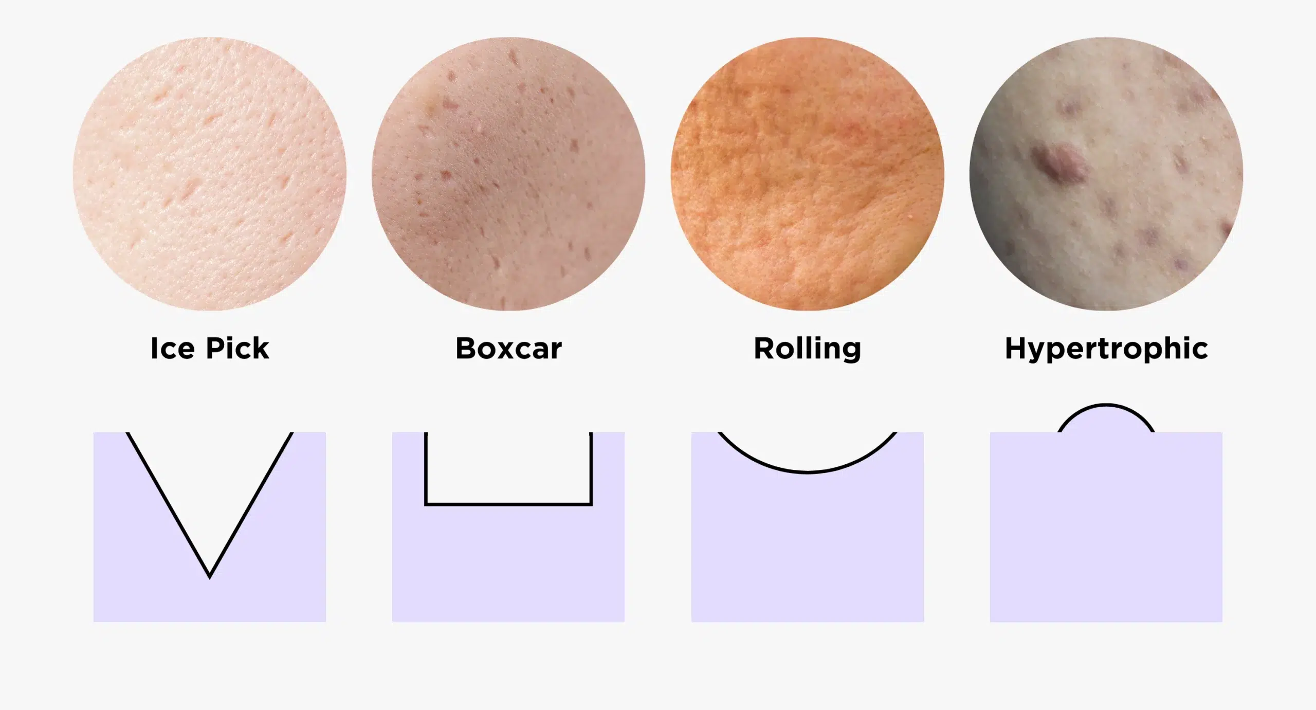 types of acne scars, ice pick scars, boxcar scars, rolling scars