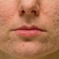 types of acne scars, how to get rid of acne scars, what do acne scars look like, what are acne scars