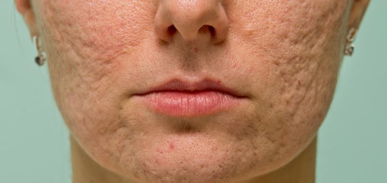 types of acne scars, how to get rid of acne scars, what do acne scars look like, what are acne scars